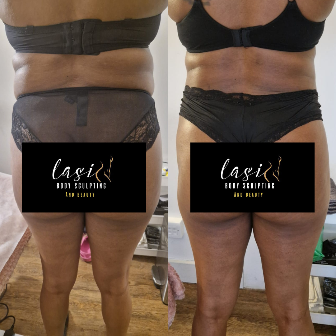 before and after mummy makeover bundle